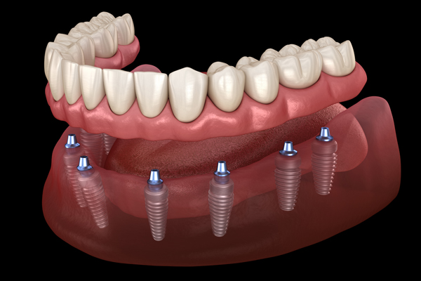 Fixed Vs  Removable Implant Supported Dentures